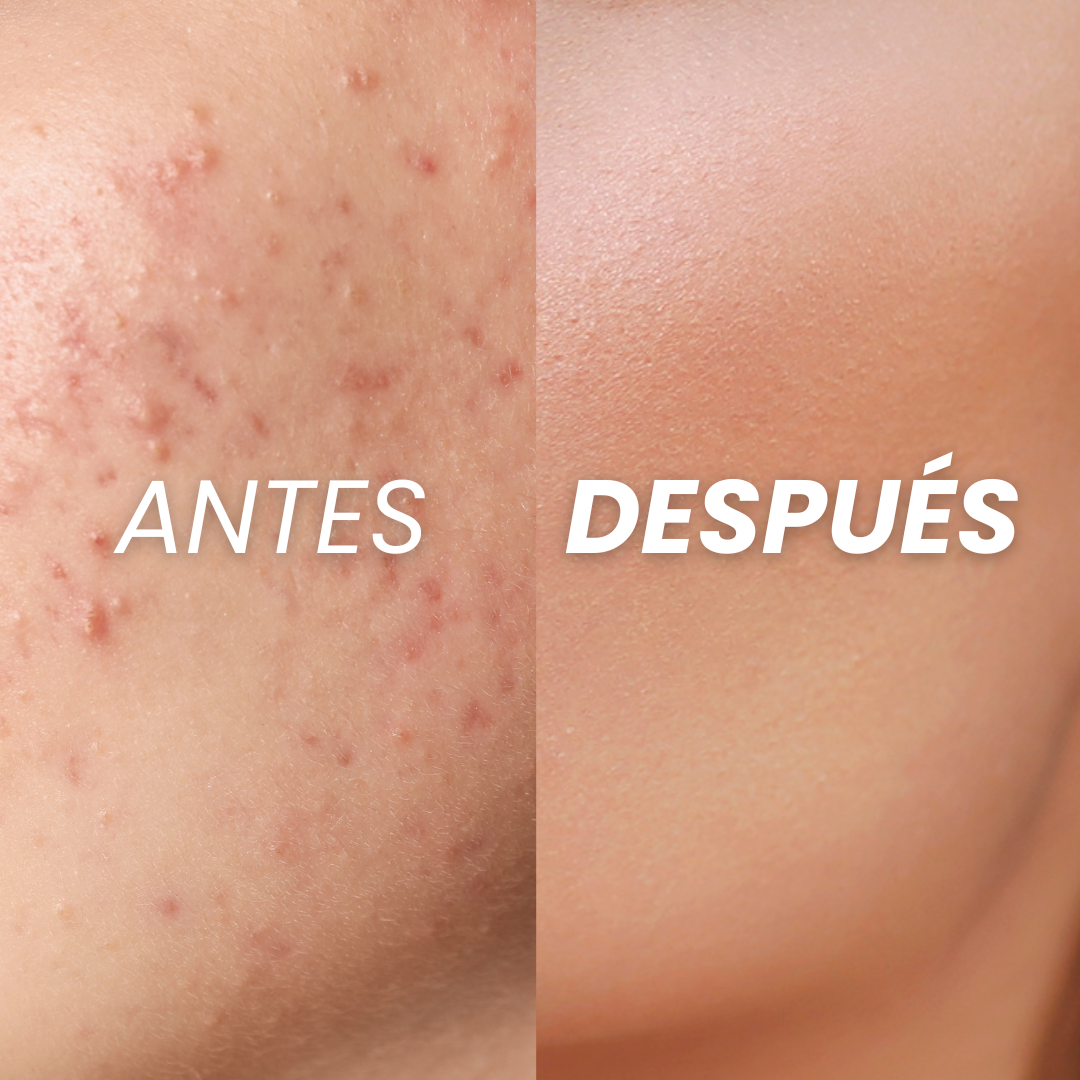 Serum Anti Acné